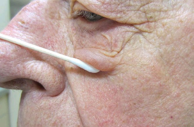 Rosacea โ periocular involvement