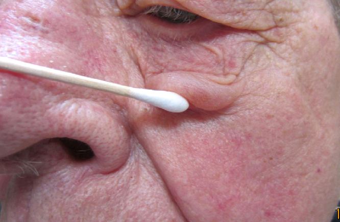 Ocular rosacea โ eyelid margin changes