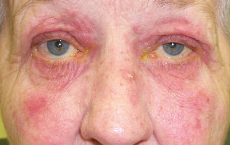 Facial rosacea โ erythema and telangiectasias